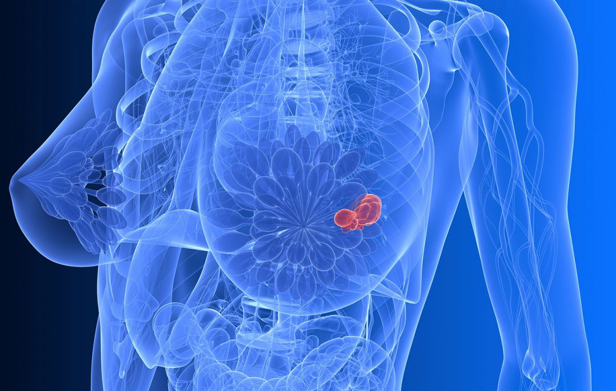 Novità sulle metastasi del tumore al seno, diagnosi più rapida grazie alla ricerca dell'Uniba